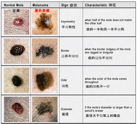 右耳朵突然長痣|痣也可能会癌变！长在 3 个地方要注意